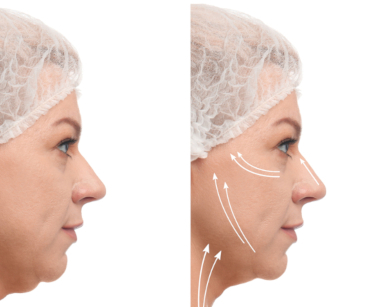 Facial tightening treatment