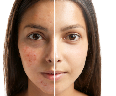 Fractional Laser Treatment in Montreal | Zena Esthétique