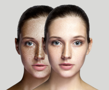 Photorejuvenation (IPL) in Montreal | Zena Esthétique